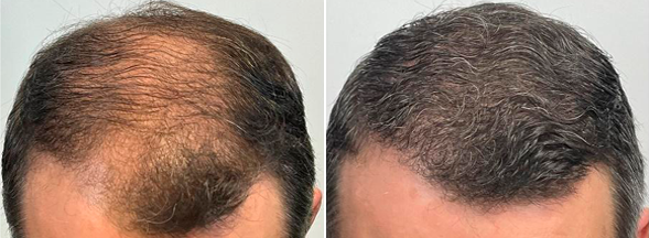 Imagem de Antes e Depois de um paciente da Audra Clínica