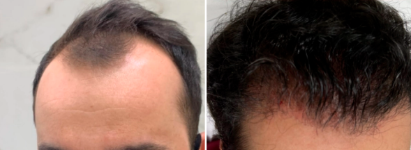 Imagem de Antes e Depois de um paciente da Audra Clínica