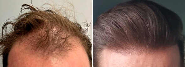 Imagem de Antes e Depois de um paciente da Audra Clínica