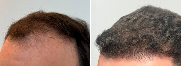 Imagem de Antes e Depois de um paciente da Audra Clínica