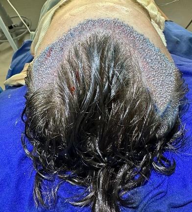 Imagem de uma operação bem sucedida com os folículos saudáveis implantados