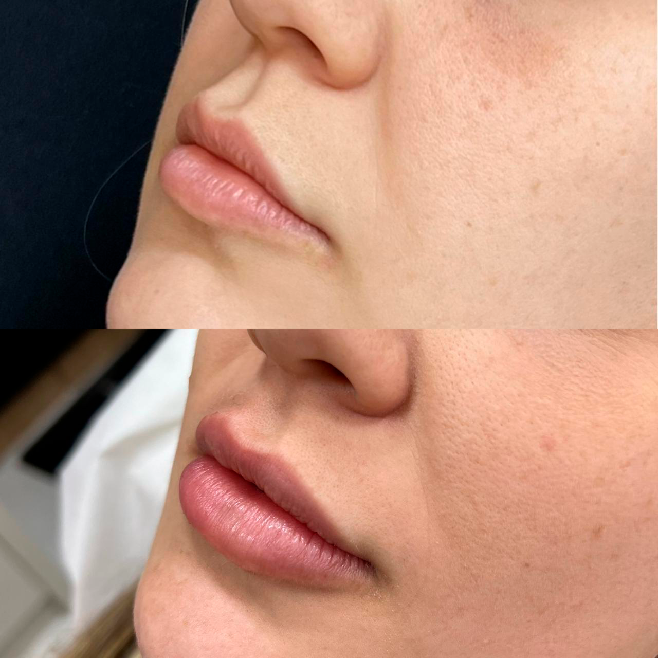 Imagem do Antes e Depois de uma mulher que recebeu os tratamentos estéticos na clínica Audra Clínica e Audra Hair Spa